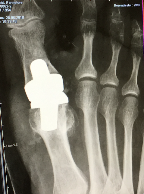 Hallux Rigidus